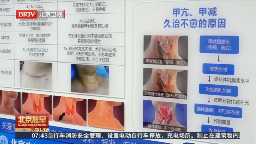 第十七届甲状腺宣传周北京电视台特别报道:探访北京北苑中医院AI辅助诊疗新突破(图4)